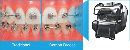 Choose-Compare-Braces