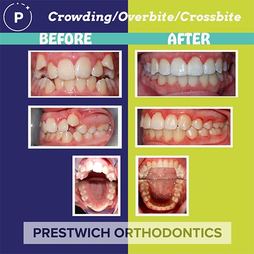Before and After Orthodontist Minot ND Invisalign Braces Prestwich