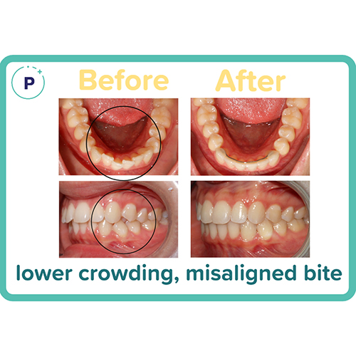 Before and After Orthodontist Minot ND Invisalign Braces Prestwich