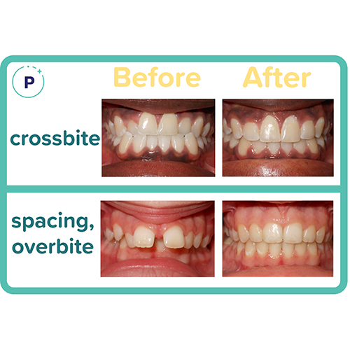 Before and After Orthodontist Minot ND Invisalign Braces Prestwich