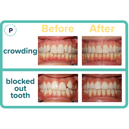 Before and After Orthodontist Minot ND Invisalign Braces Prestwich