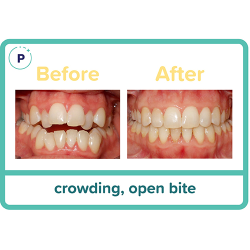 Before and After Orthodontist Minot ND Invisalign Braces Prestwich
