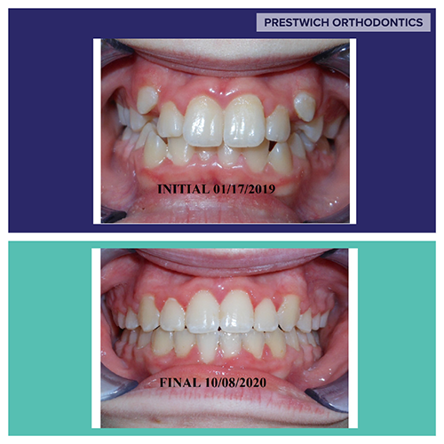 Before and After Orthodontist Minot ND Invisalign Braces Prestwich