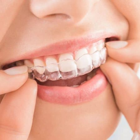 Teen Orthodontics Before After Orthodontic Treatment Prestwich Orthodontics in Minot, ND